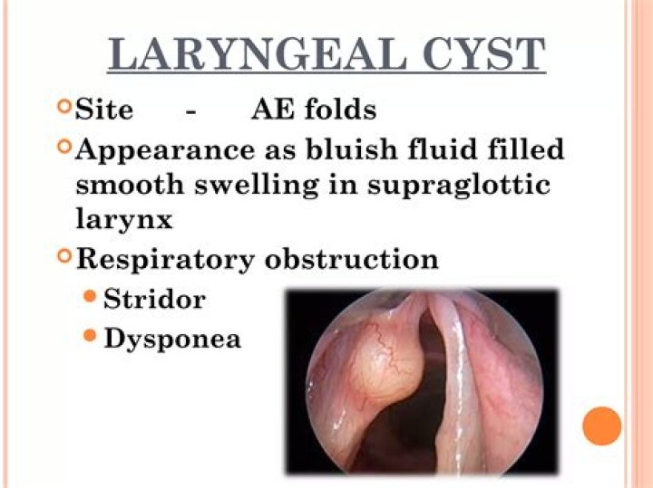 Are laryngeal cysts life threatening?