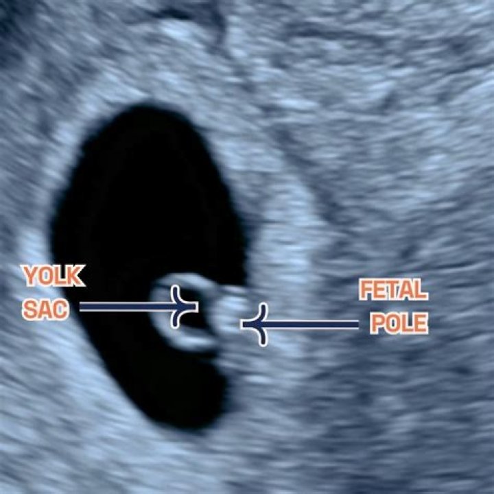 Can 6 weeks pregnancy be detected in ultrasound?