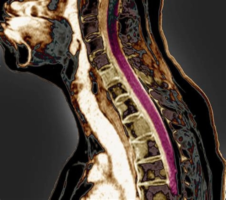 Can breast cancer spread to cervical spine?