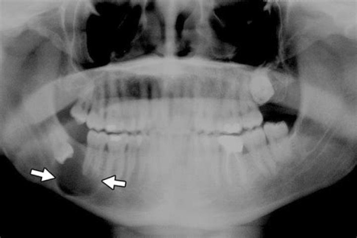 Can cysts in the jaw be cancerous?