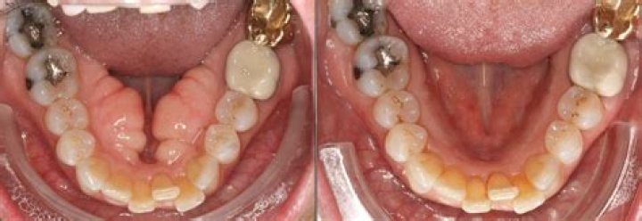 Can I get dentures with Torus Palatinus?