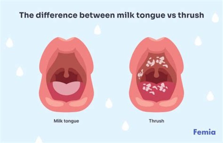Can milk build up on baby tongue cause thrush?