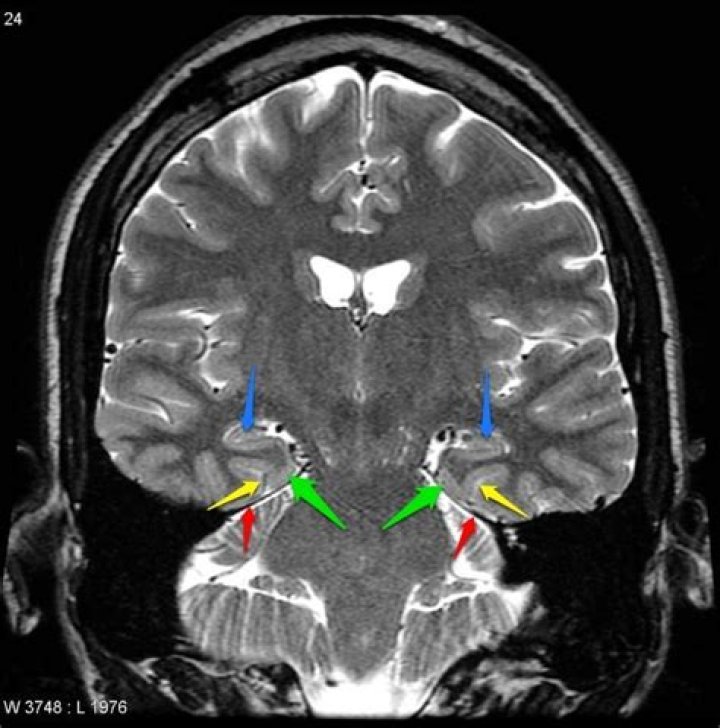 Can the hippocampus be seen on MRI?