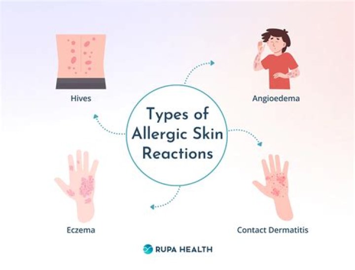 Can you be allergic to potassium iodine?