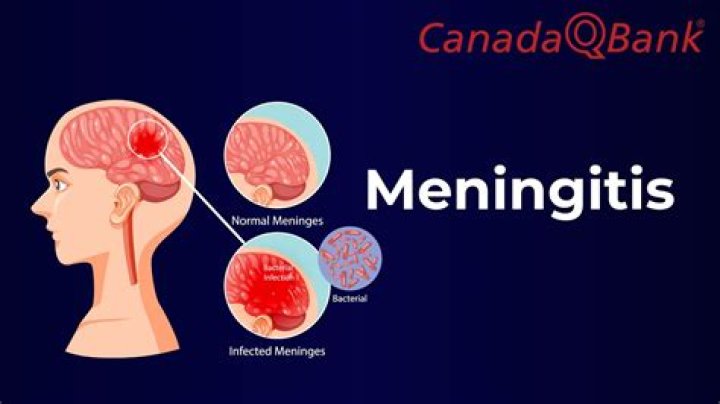 Can you get meningitis from surgery?