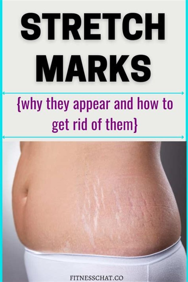 Can you get stretch marks from wearing a bra?