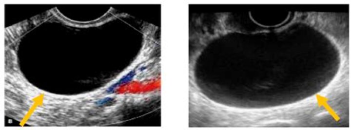 Can you have ovarian cyst and endometriosis?