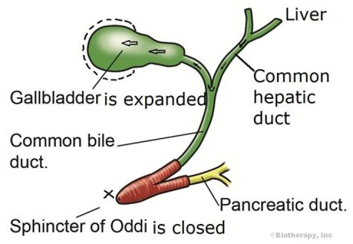 Can you have sphincter of Oddi dysfunction after gallbladder removal?