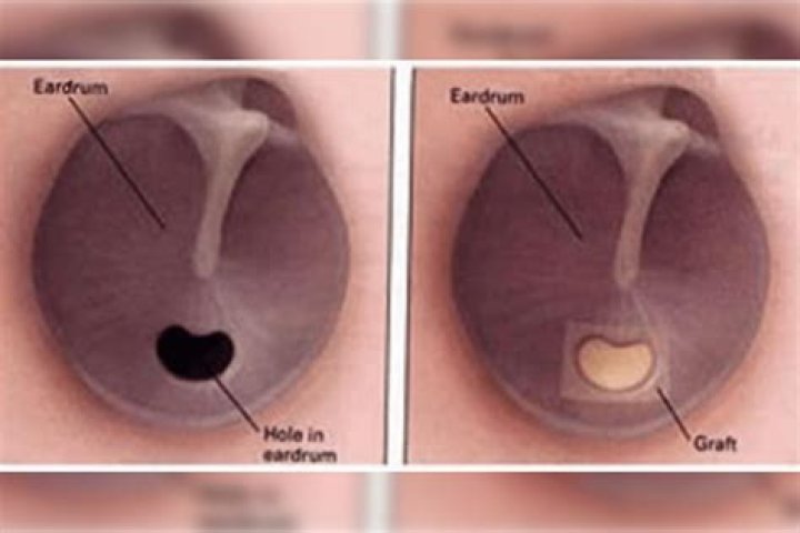 Can you rupture your eardrum if you have tubes?