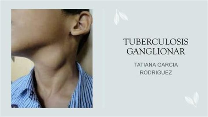 Como detectar tuberculosis ganglionar?