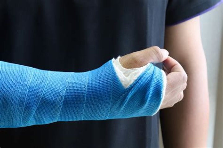 Do you put a cast on a sprain?
