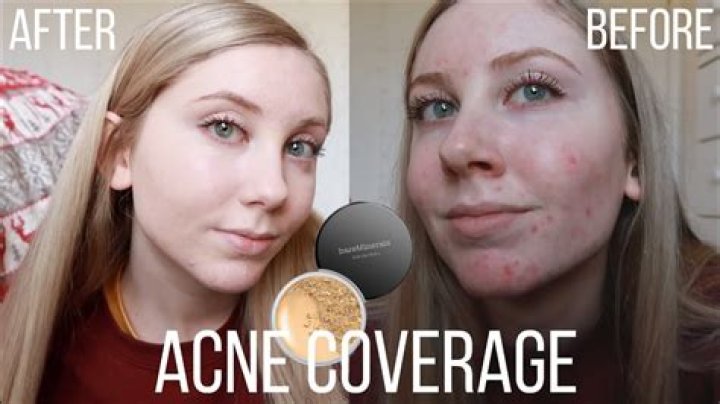 Does Bare Minerals foundation cover acne?