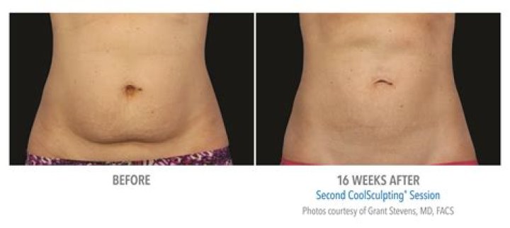 Does fat reduction body contouring work?