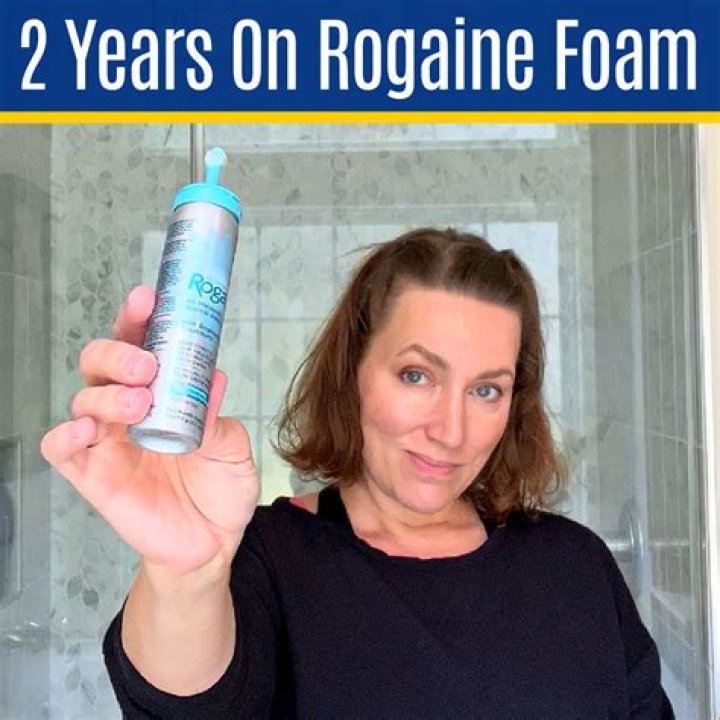 Does Rogaine work if totally bald?