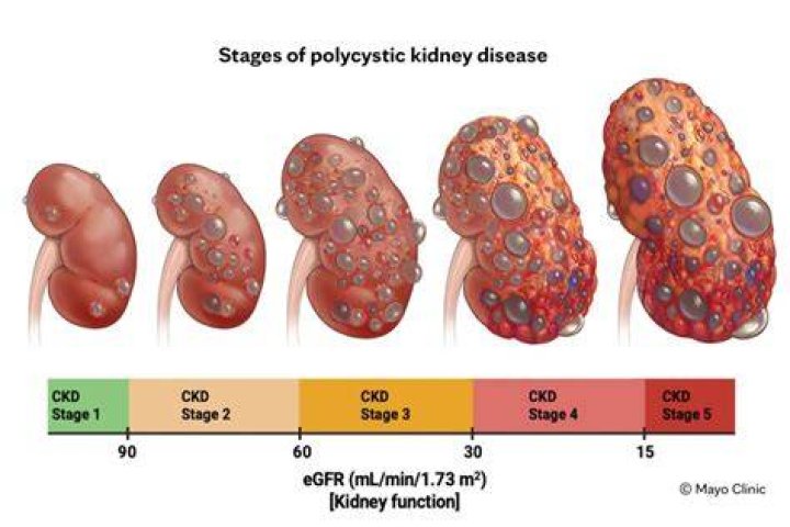 How big is a kidney with PKD?