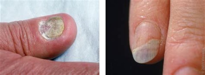 How can I get rid of fingernail fungus?