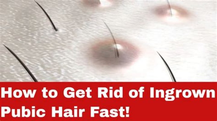 How do I get rid of an ingrown hair on my labia?