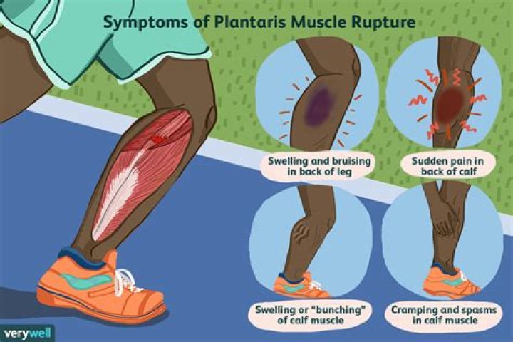 How do you know if you pulled a muscle in your leg?