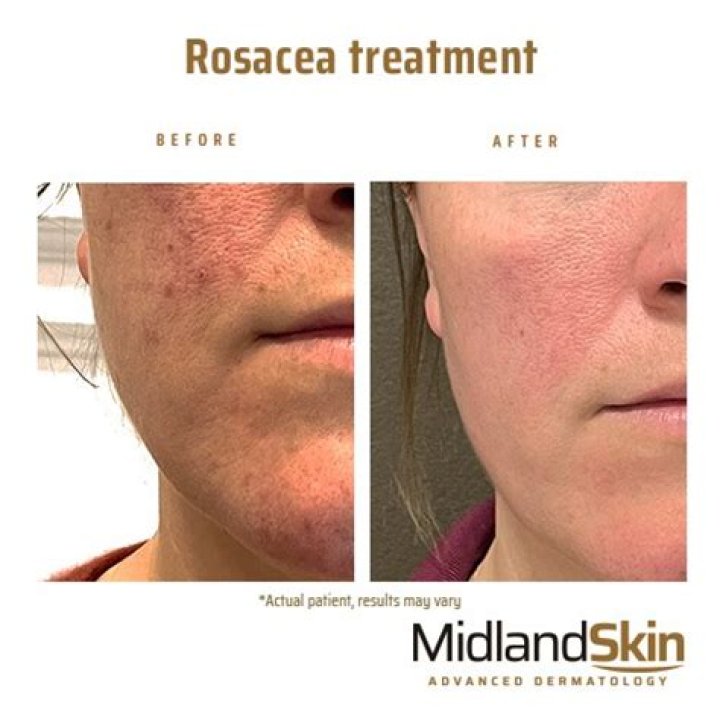 How do you stop rosacea flushing?