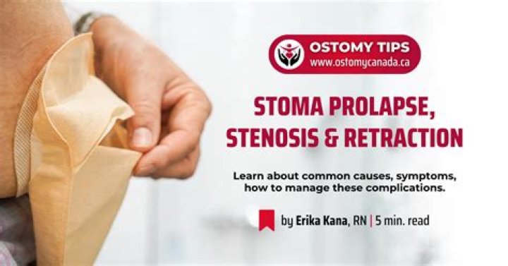 How is a prolapsed stoma treated?