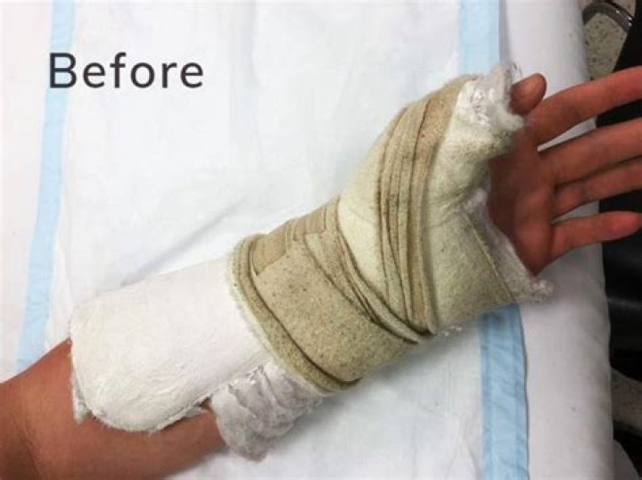 How long do you have to wear a cast after scaphoid surgery?