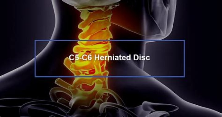 How long does C5 c6 surgery take?