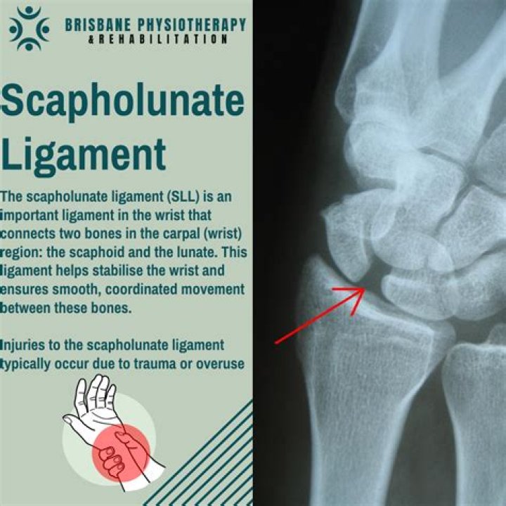 How long does it take for a scapholunate ligament tear to heal?