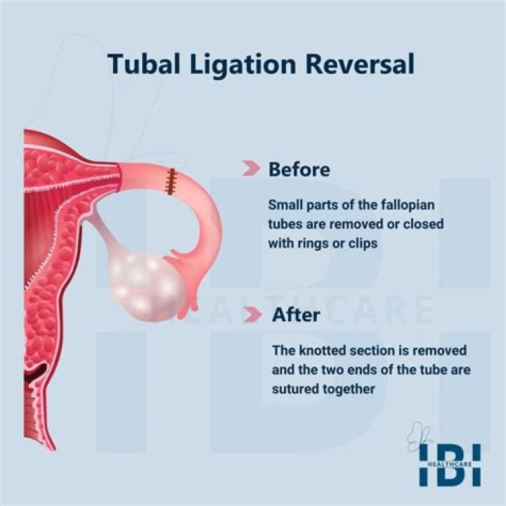 How long does tubal ligation pain last?