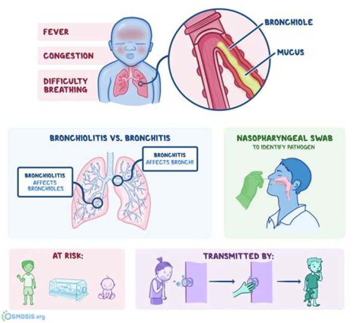 Is bronchitis a symptom of Covid?