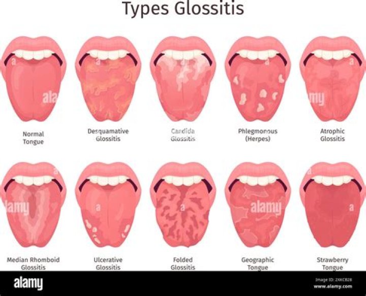 Is glossitis a fungal infection?
