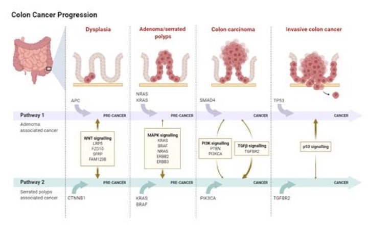 Is high-grade dysplasia in a colon polyp cancer?