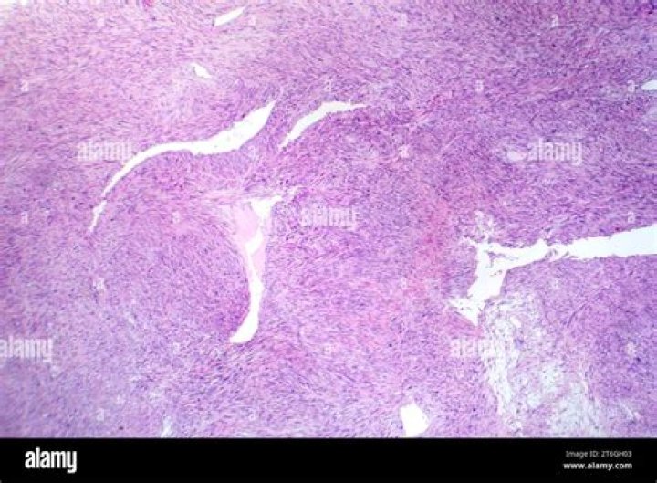 Is leiomyosarcoma an aggressive cancer?