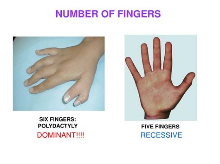 Is six fingers a dominant or recessive trait?