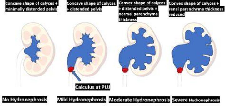 What are the different grades of hydronephrosis?
