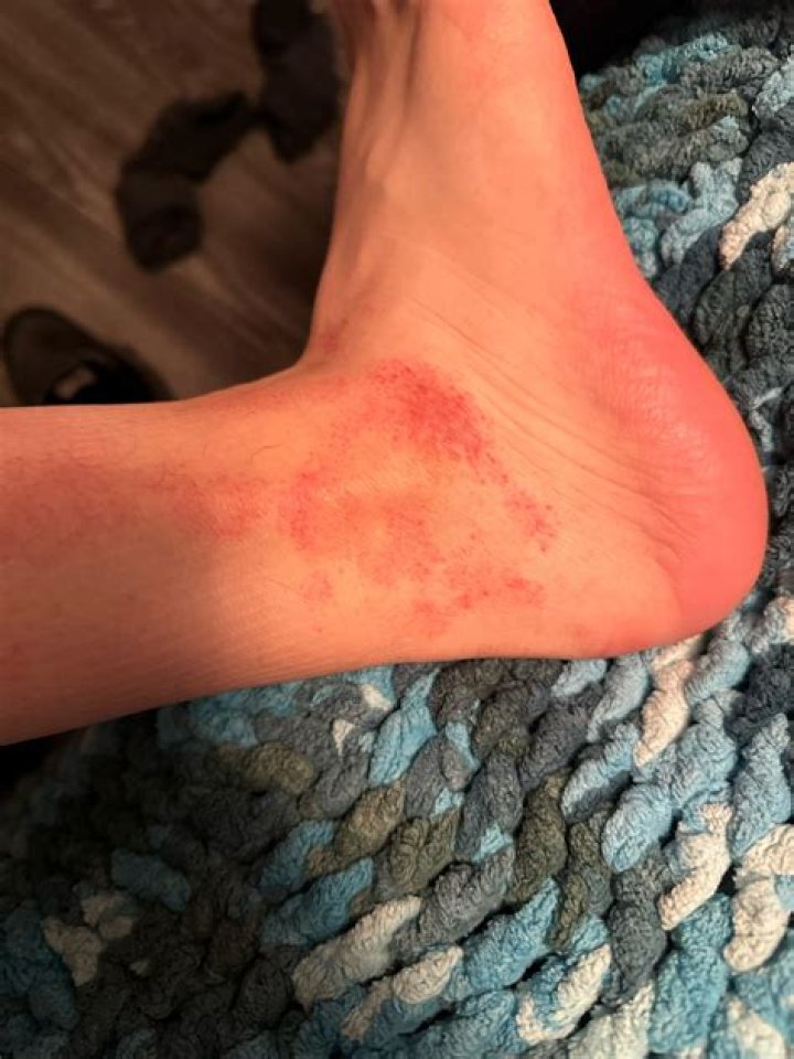 What are the red blotches on my ankles?