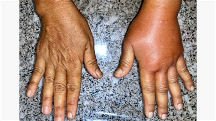 What causes inflammation in hands and feet?