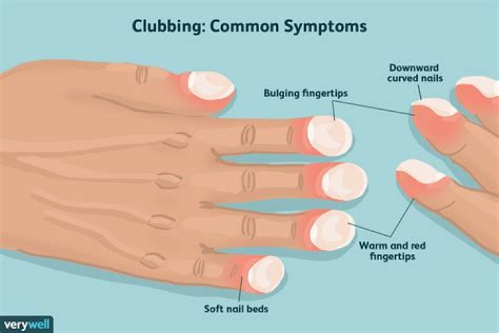 What does digital clubbing indicate?