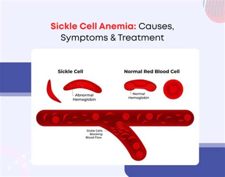 What happens if someone is heterozygous for sickle cell anemia?