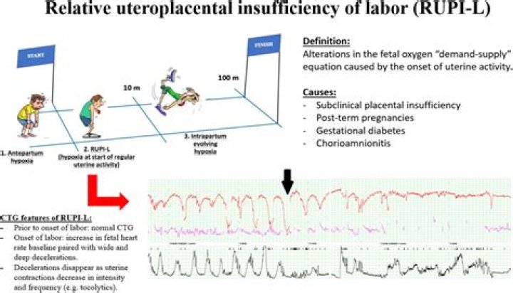 What indicates Uteroplacental insufficiency?