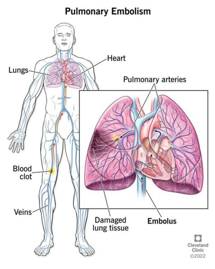 What is a PE in medical terms?