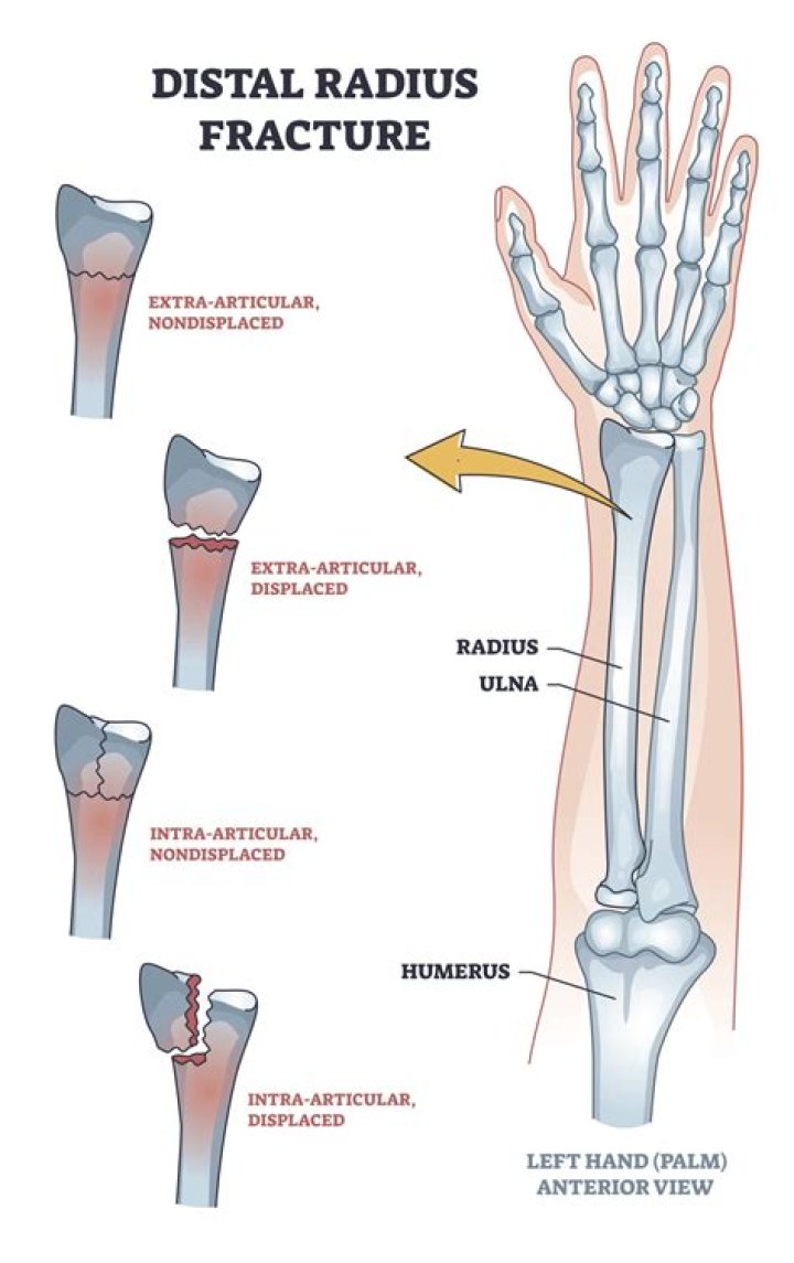 What is a radial bifurcation?