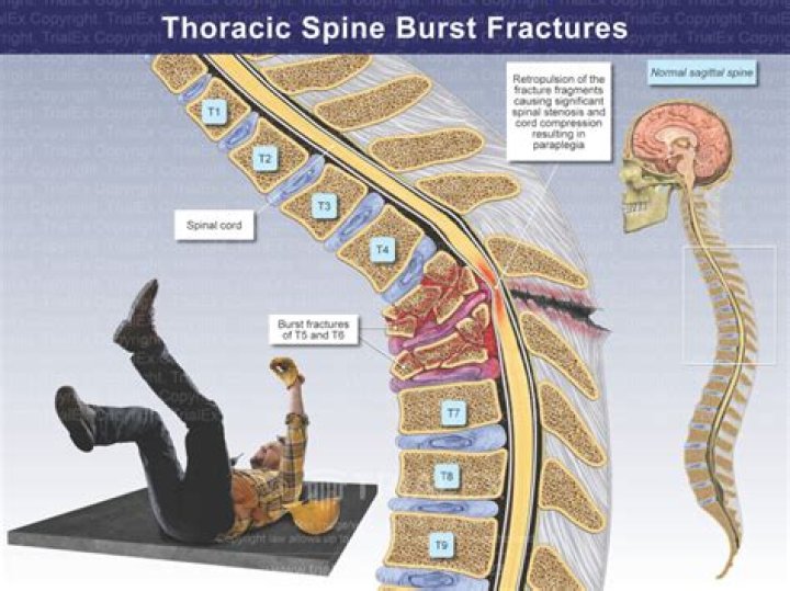 What is a T5 injury?
