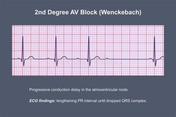 What is a Wenckebach rhythm?