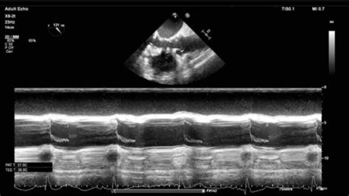 What is B-mode in echocardiography?