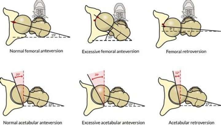 What is bilateral acetabular Retroversion?