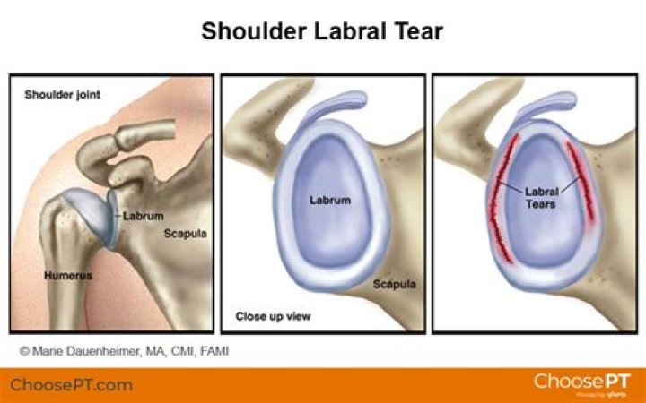 What is chondral loss in the shoulder?