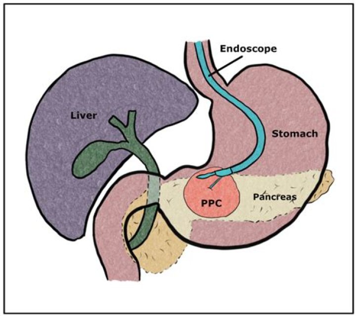 What is endoscopic Cystogastrostomy?