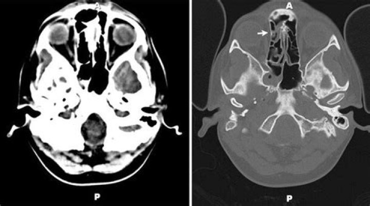What is ethmoid sinus mucosal thickening?