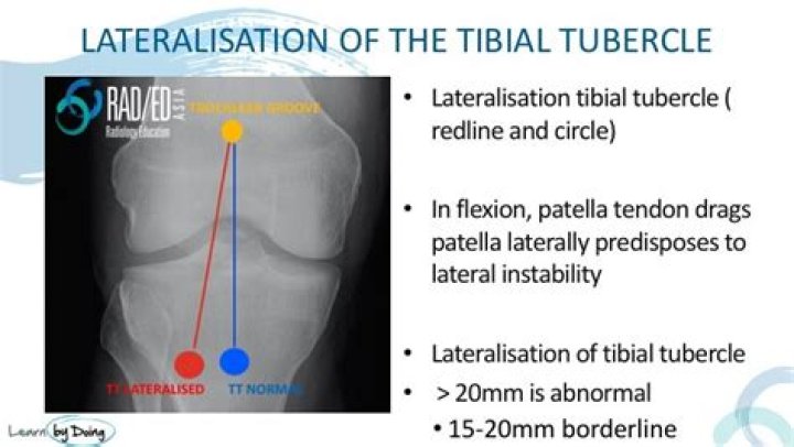 What is lateralization of tibial tuberosity?