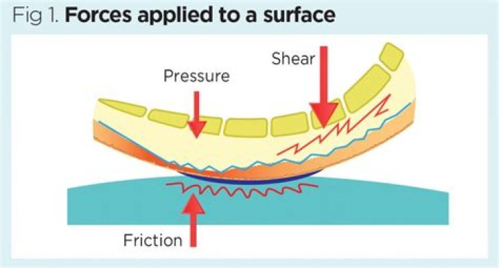 What is shearing force in nursing?